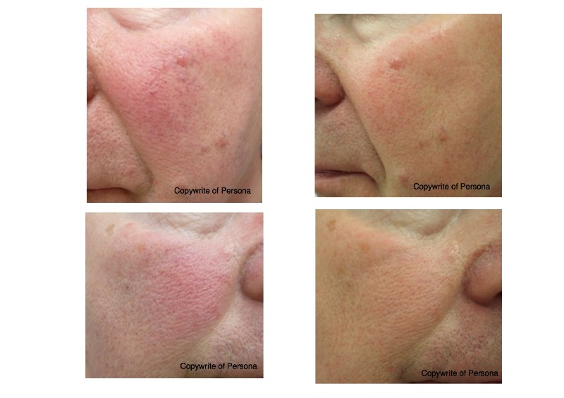 PhotoFacial Rejuvenation for redness  Photo